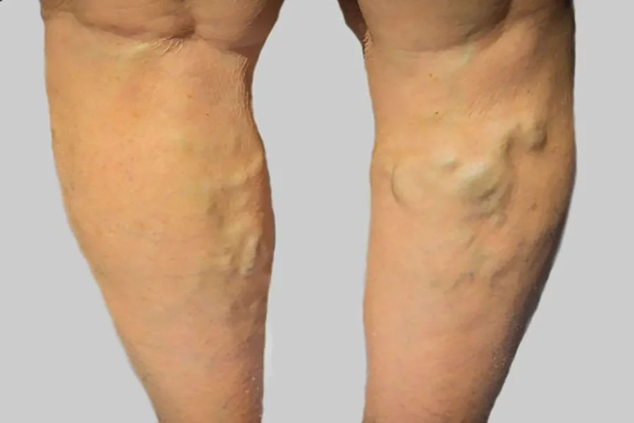 Varicose Vein Treatments