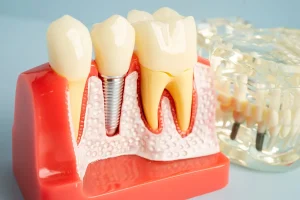 Essential Information about Dental Implants